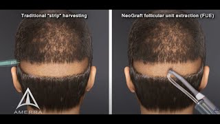 NeoGraft hair transplant procedure  animation [upl. by Freberg]