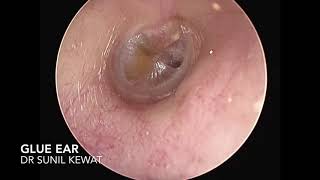 Glue Ear on Valsalva Maneuver  Note Bubbles Behind Ear Drum [upl. by Nylesoj]