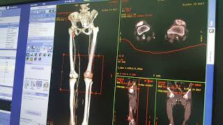 3D CT Scan leg [upl. by Anaeli]