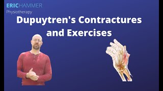 Dupuytrens Contractures and Exercises [upl. by Ennahgiel]