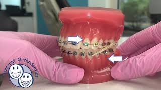 Elastics in Orthodontics  Overview [upl. by Anitreb]