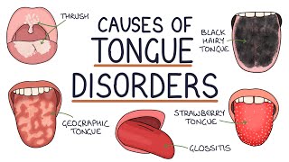 Understanding Tongue Disorders Causes and Management [upl. by Cummings]