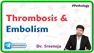 13 Thrombosis And Embolism  USMLE Step 1 Pathology [upl. by Neslund]