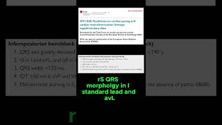 ECG criteria of LEFT POSTERIOR FASCICULAR BLOCK [upl. by Ellan594]