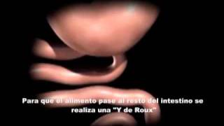 Bypass gastrico laparoscopico 2wmv [upl. by Henrietta]