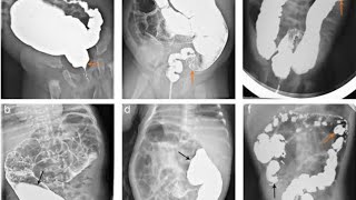 Barium Enema  Single and Double part 2 [upl. by Anerol]