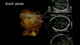 Practical Approaches to Fetal CNS Evaluation [upl. by Neliac]