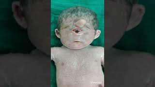 cyclopia synopthalmia holoprosencephaly proboscis patausyndrome [upl. by Hashim]