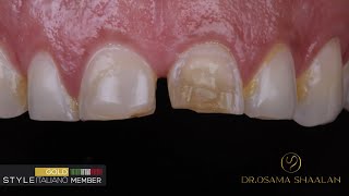 Diastema closure using direct bonding Direct composite veneers with simplified approach [upl. by Rizika634]