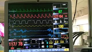 Adenosine induced transient cardiac arrest [upl. by Robinet]