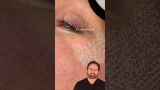 Fractional CO2 Laser Treatment Surgeon Reacts [upl. by Noived]