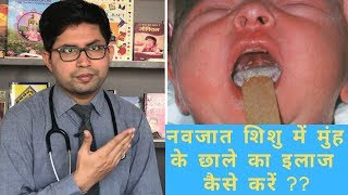 Oral candidiasis  Oral white patch  How to manage Oral thrush in baby  how to clean baby mouth [upl. by Annora]