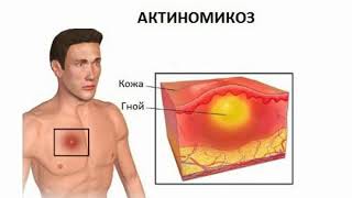 Actinomycosis Treatment Symptoms Causes [upl. by Jenni899]