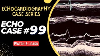 ECHO CASE 99  Echocardiography for Beginners  M Mode Echocardiogram [upl. by Htedirem]