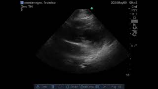 paraesternal corto apical [upl. by Eadnus81]