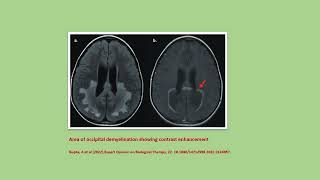 Neurology Quiz 91 Adrenoleukodystrophy [upl. by Elime847]