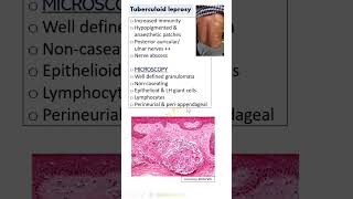 Shorts Tuberculoid amp lepromatous leprosy Dr GSS SRM MCH RC [upl. by Ettenrahs955]