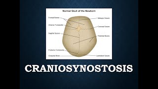 Craniosynostosis  an overview [upl. by Eetsud]