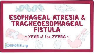 Esophageal atresia amp tracheoesophageal fistula Year of the Zebra [upl. by Aninaig]