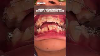 Ceramic Dental Braces Fixing Process  dentalbraces braces invisiblebraces orthodontictreatment [upl. by Kappel]