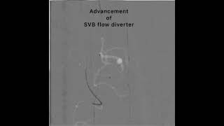 Flow Diverter Treatment for Dissecting Aneurysm [upl. by Alfonse]