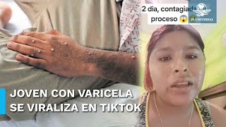 Joven se viraliza tras confundir viruela del mono con varicela [upl. by Kinsman863]