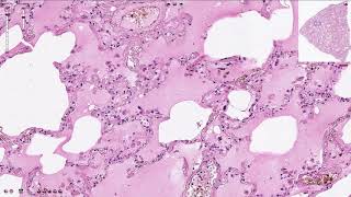 Pulmonary Edema  Histopathology [upl. by Chrissie]