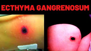 WHAT IS ECTHYMA GANGRENOSUM Causes Symptoms [upl. by Niawat]