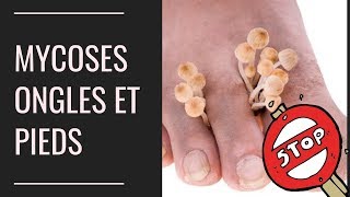 Mycoses des pieds et des ongles  Larme absolue pour sen débarrasser rapidement [upl. by Maxy202]