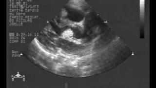 echocardiogram multiple rhabdomyoma tumorLong axis view [upl. by Ahcsap]