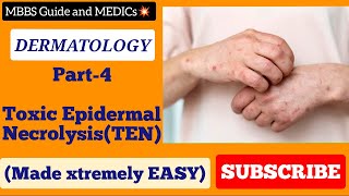 Toxic Epidermal Necrolysis made EASY UrduHindi mbbsguide mbbsguideandmedics [upl. by Diva]