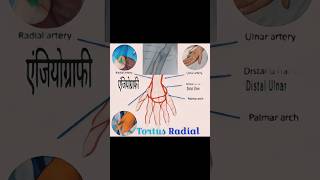 Tortous Radial Artery  रेडियल नसArteryका घुमावदार रास्ता😱😱😱कैसे पार किया देखें विडियो cathlab [upl. by Keldah]