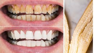 Whitening Teeth Home Remedies To remove Stains and Get White Teeth Overnight [upl. by Nithsa]