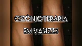 ozonioterapia em varizes Aplicação de ozônio em varizes [upl. by Orme75]