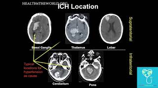 Intracerebral Hemorrhage Part 2  Health4TheWorld Academy [upl. by Xuerd]