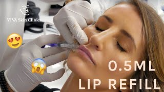 05ML LIP REFILL  NATURAL LOOKING FULL LIPS  LIP FILLERS  VIVA Skin Clinics [upl. by Conti]