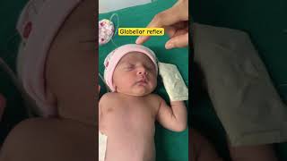 Reflex examination physiology  palmar reflex in newborn  Glabellar reflex in newborn  youtube [upl. by Gnov407]