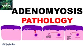 ADENOMYOSIS  Pathology Clinical Features Diagnosis amp treatment [upl. by Wilie]