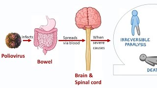 Poliomyelitis medicalsurgicalnursing 2gnm 2nd Gnm [upl. by Teddy]