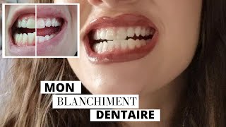 BLANCHIMENT DENTAIRE  chez le dentiste  prix durée etc JE VOUS DIS TOUT [upl. by Vullo206]