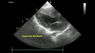 paraesternal eje largo [upl. by Maurilla88]