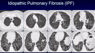 CHEST 2016 video sessions HRCT of the chest [upl. by Mudenihc]