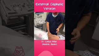 External Cephalic Version for baby breech presentation shorts obstetrics birth cesareanbirth [upl. by Akemhs]