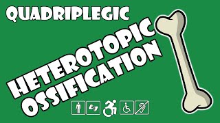 Heterotopic Ossification HO Explained  Quadriplegic C5C6C7 [upl. by Fanchette34]