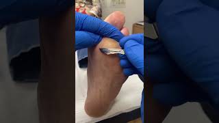 Uncover smooth feet Watch an Australian Podiatrist remove forefoot callus [upl. by Jareb]