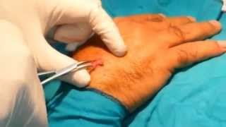 Scarless ganglion cyst كيس زلالي باليد بدون أثر  تجنب الندوب أفضل من علاجها [upl. by Enial398]