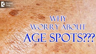 5 Quick Remedies to Reduce Age Spot naturalremedies [upl. by Sjoberg19]