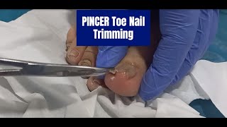 NonInvasive Pincer Uncut Toenail Trimming Effective Techniques and Prevention [upl. by Aceissej47]