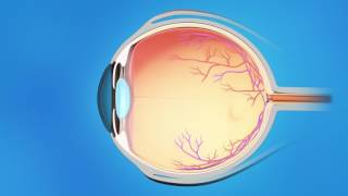 Understanding Glaucoma [upl. by Htebizile198]