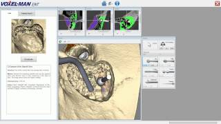 Exposure of the Sigmoid Sinus with VoxelMan Tempo [upl. by Hairej300]